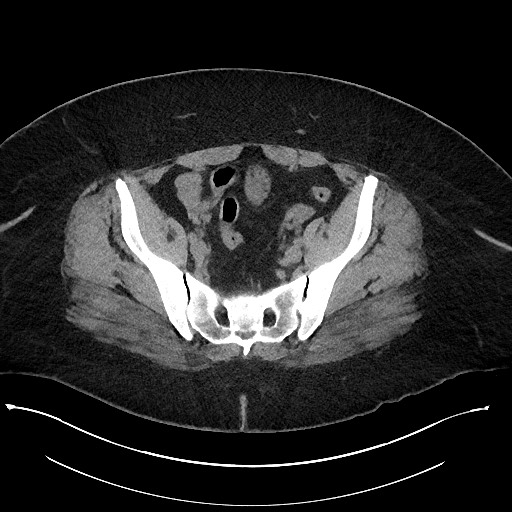 File:Carcinoid tumor - terminal ileum (Radiopaedia 60931-68740 Axial non-contrast 95).jpg