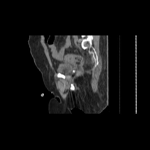 File:Carcinoma cervix- brachytherapy applicator (Radiopaedia 33135-34173 D 124).jpg
