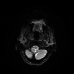 Carcinoma ex-pleomorphic adenoma of parotid (Radiopaedia 28383-28627 Ax DWI B-500 GE 20).jpg