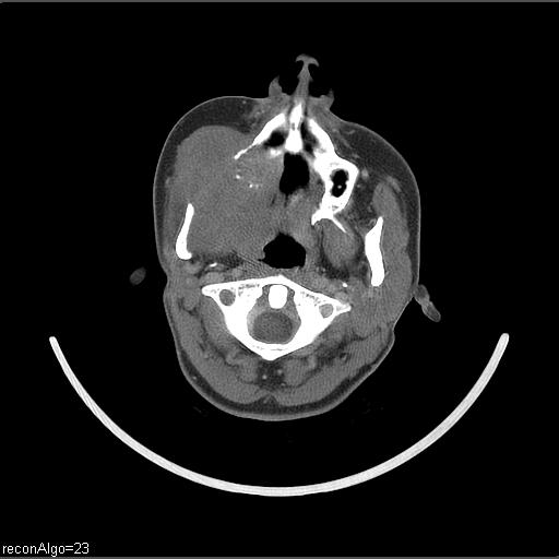 File:Carcinoma of the maxillary antrum (Radiopaedia 53805-59888 Axial C+ delayed 47).jpg
