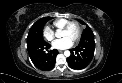 Cardiac sarcoidosis (Radiopaedia 74548-85534 A 52).jpg