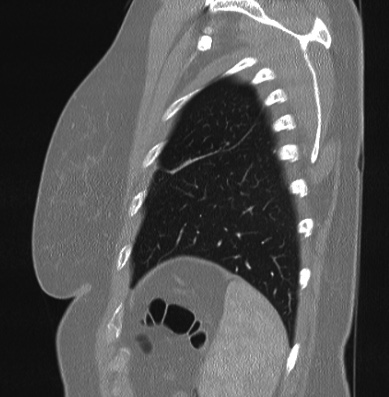 Cardiac sarcoidosis (Radiopaedia 74548-85534 Sagittal lung window 11).jpg