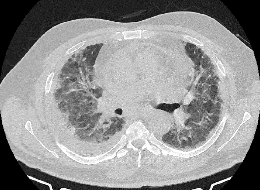 Cardiogenic pulmonary edema (Radiopaedia 68180-77678 Axial lung window 43).jpg