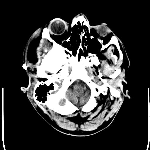 File:Carotid arterial dissection (Radiopaedia 30001-30548 Axial non-contrast 2).jpg