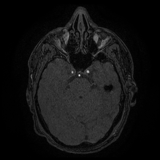 Carotid arterial dissection with acute cerebral infarction (Radiopaedia 26636-26784 MRA 116).jpg