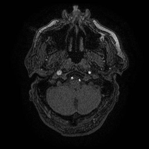 Carotid arterial dissection with acute cerebral infarction (Radiopaedia 26636-26784 MRA 157).jpg