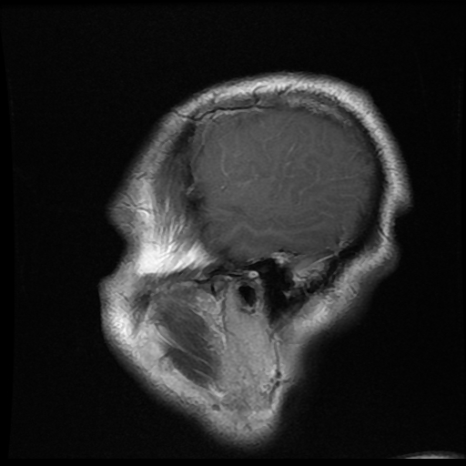File:Carotid arterial dissection with acute cerebral infarction (Radiopaedia 26636-26784 Sagittal T1 C+ 19).jpg