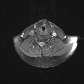 File:Carotid artery dissection (Radiopaedia 28441-28689 Axial T1 fat sat 16).jpg