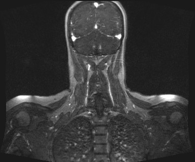 Carotid body tumor (Radiopaedia 12777-12912 MRA 62).jpg