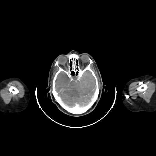File:Carotid body tumor (Radiopaedia 21021-20948 A 6).jpg