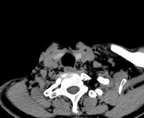 File:Carotid body tumor (Radiopaedia 61750-69757 Axial non-contrast 100).jpg
