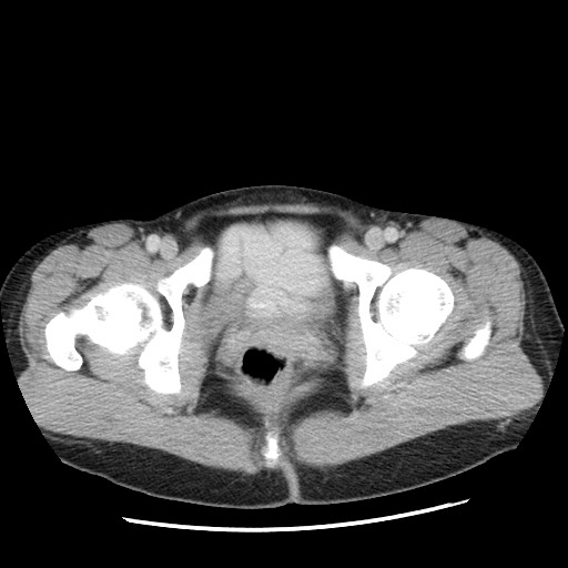 Castleman disease with fibrous pseudotumor in the abdomen (Radiopaedia 77296-89373 A 124).jpg
