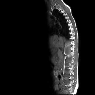 File:Caudal regression syndrome (Radiopaedia 61990-70072 Sagittal T1 1).jpg