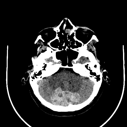 Cavernous hemangioma of the cerebellar falx (Radiopaedia 73025-83723 Axial non-contrast 32).jpg
