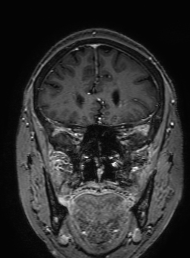 Cavernous hemangioma of the cerebellar falx (Radiopaedia 73025-83724 Coronal T1 C+ 111).jpg