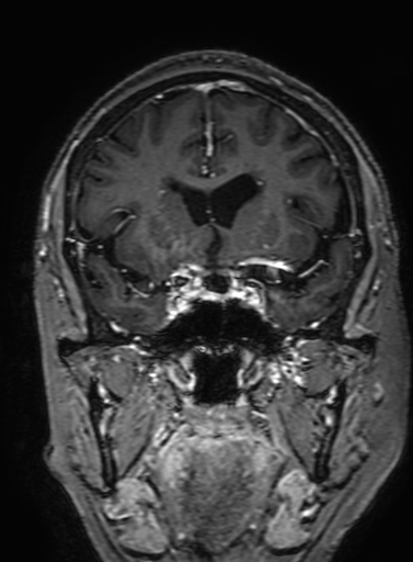 Cavernous hemangioma of the cerebellar falx (Radiopaedia 73025-83724 Coronal T1 C+ 138).jpg