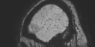 Cavernous hemangioma of the cerebellar falx (Radiopaedia 73025-83724 Sagittal BOLD 183).jpg
