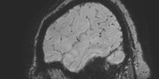 Cavernous hemangioma of the cerebellar falx (Radiopaedia 73025-83724 Sagittal BOLD 29).jpg