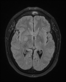 File:Cavernous sinus meningioma (Radiopaedia 63682-72367 Axial FLAIR 12).jpg