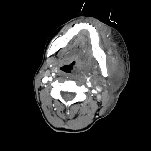 File:Cavernous sinus thrombosis (Radiopaedia 10619-11078 A 16).jpg