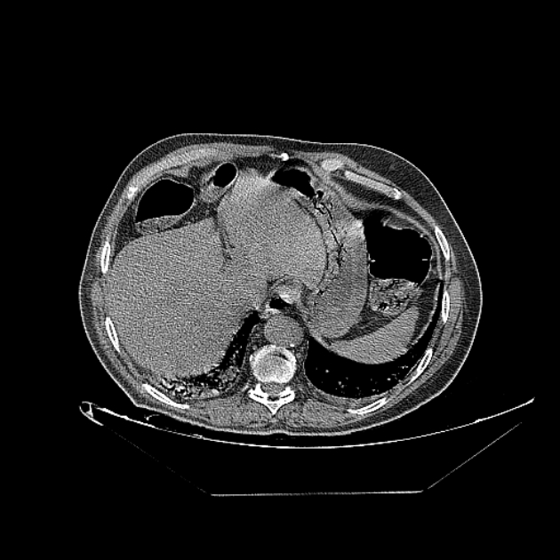 Cavitating bronchogenic carcinoma (Radiopaedia 44489-48162 Axial non-contrast 76).jpg