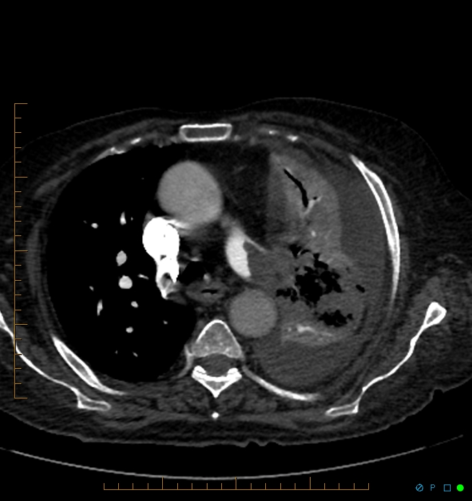 Cavitating pulmonary infarction (Radiopaedia 54634-60849 Axial C+ CTPA 24).jpg