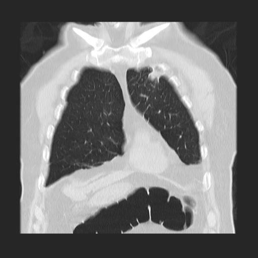 File:Cavitating pulmonary metastases (Radiopaedia 89545-106544 Coronal lung window 9).jpg
