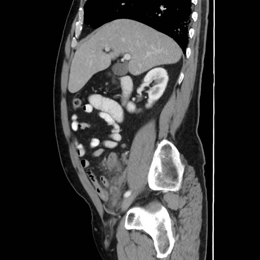 Cecal mass causing appendicitis (Radiopaedia 59207-66531 C 21).jpg