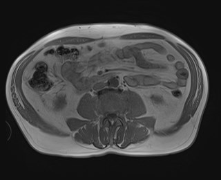 Cecal mass causing appendicitis (Radiopaedia 59207-66532 Axial T1 in-phase 76).jpg