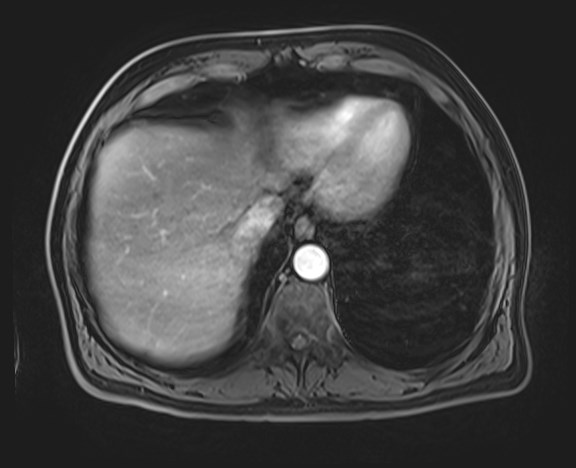 Cecal mass causing appendicitis (Radiopaedia 59207-66532 H 26).jpg