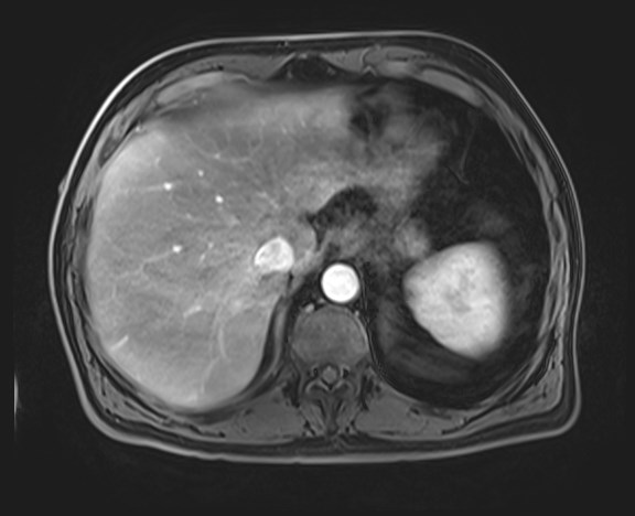 Cecal mass causing appendicitis (Radiopaedia 59207-66532 H 31).jpg