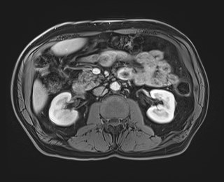 Cecal mass causing appendicitis (Radiopaedia 59207-66532 T1 C+ PV phase 62).jpg