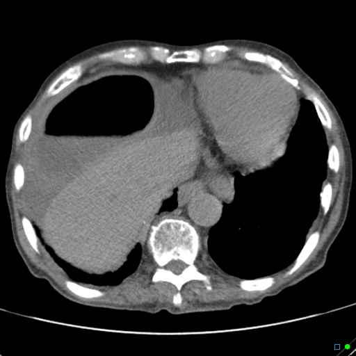 Cecal volvulus - atypical (Radiopaedia 21637-21588 non-contrast 7).jpg