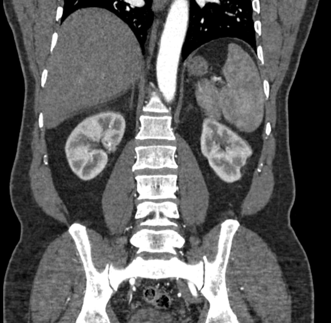 Celiac artery dissection (Radiopaedia 52194-58080 C 108).jpg