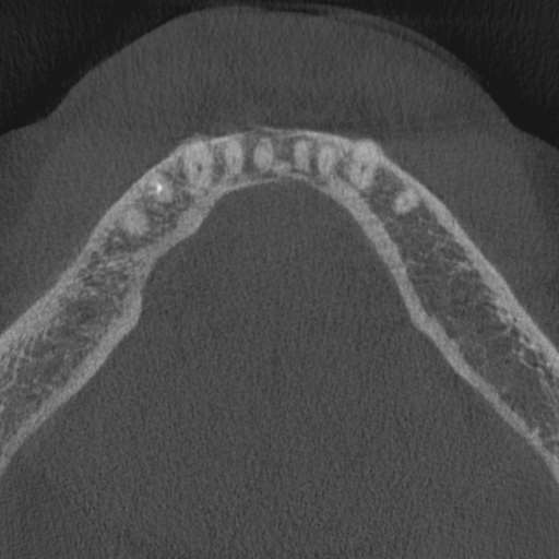 Cemento-osseous dysplasia (Radiopaedia 48251-53126 Axial non-contrast 25).jpg
