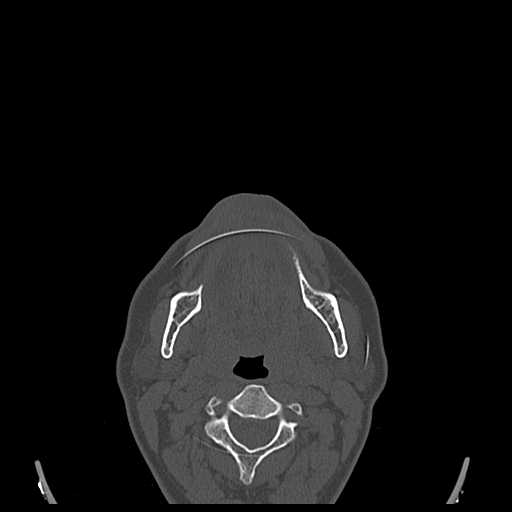 File:Cemento-ossifying fibroma (Radiopaedia 21243-21149 Axial bone window 11).jpg