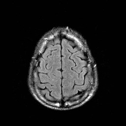 File:Central-variant posterior reversible encephalopathy syndrome (PRES) (Radiopaedia 43880-47358 Axial FLAIR 21).jpg