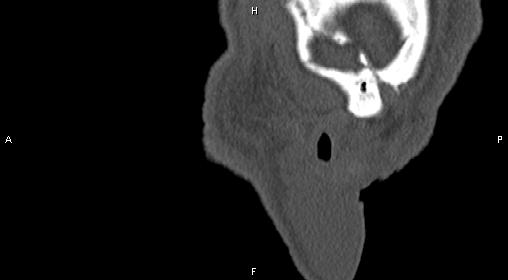 File:Central giant cell granuloma (Radiopaedia 83346-97761 Sagittal bone window 47).jpg