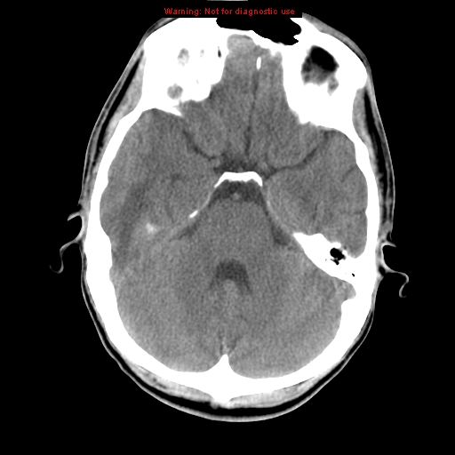 File:Central nervous system vasculitis (Radiopaedia 8410-9234 Axial non-contrast 32).jpg