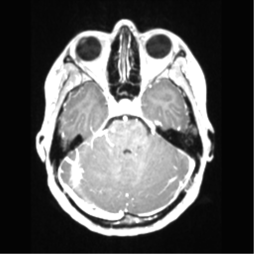 File:Central neurocytoma (Radiopaedia 37664-39557 Axial T1 C+ 26).png