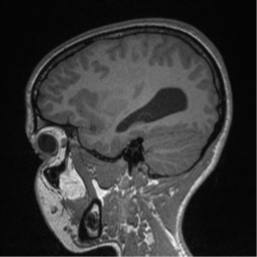 Central neurocytoma (Radiopaedia 37664-39557 Sagittal T1 28).png