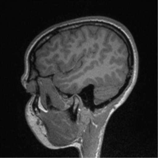 Central neurocytoma (Radiopaedia 37664-39557 Sagittal T1 76).png