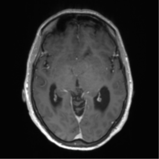 Central neurocytoma (Radiopaedia 65317-74345 Axial T1 C+ 23).png