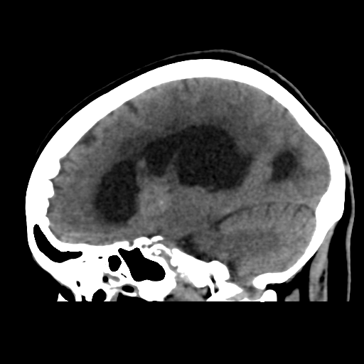File:Central neurocytoma (Radiopaedia 65317-74346 C 32).png