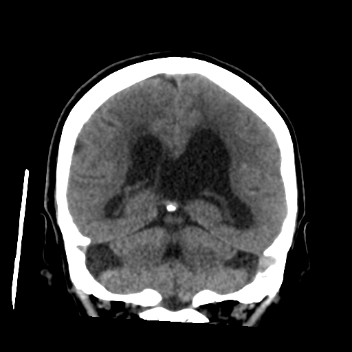 Central neurocytoma (Radiopaedia 65317-74346 Coronal non-contrast 39).png