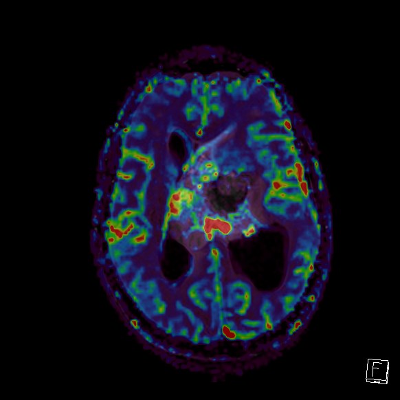 Central neurocytoma (Radiopaedia 84497-99872 Axial Perfusion 133).jpg