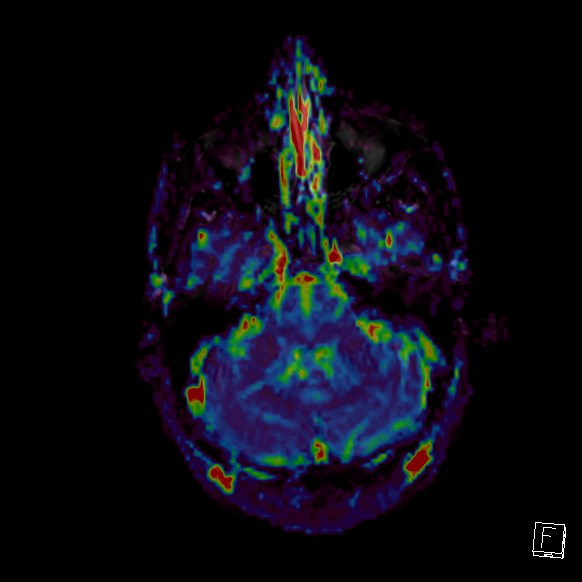 Central neurocytoma (Radiopaedia 84497-99872 Axial Perfusion 253).jpg