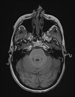 Central neurocytoma (Radiopaedia 84497-99872 Axial T1 61).jpg