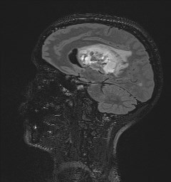 File:Central neurocytoma (Radiopaedia 84497-99872 Sagittal Flair + Gd 67).jpg