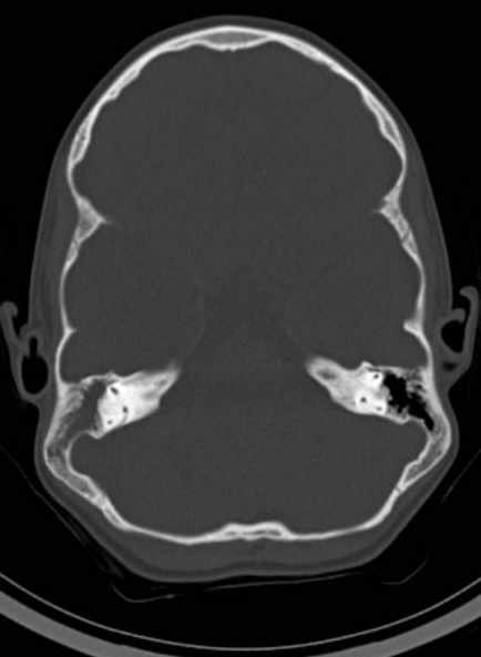 Cerebellar abscess (Radiopaedia 73727-84527 Axial bone window 27).jpg
